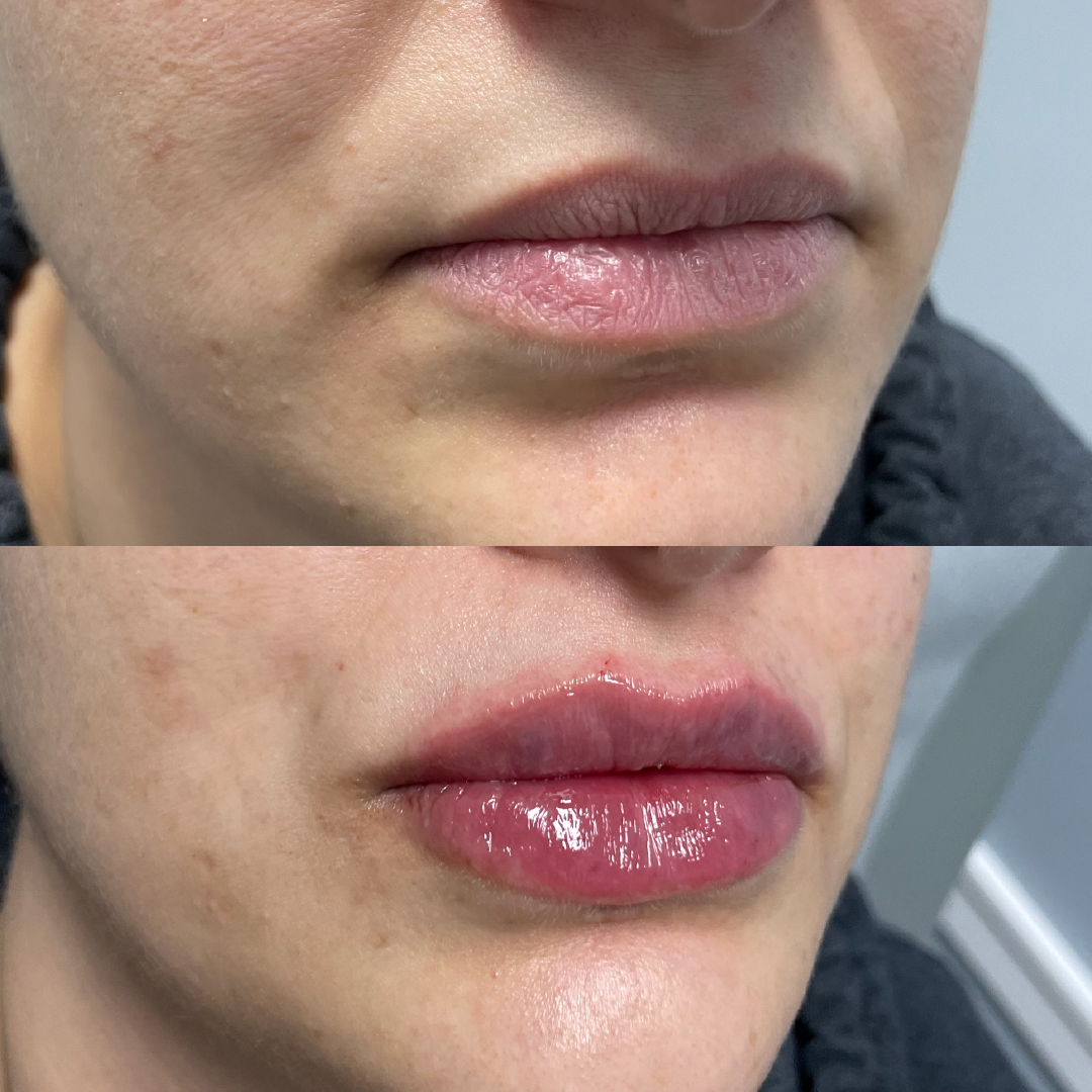 Comparison: top shows thin lips, bottom shows fuller lips, likely after lip filler injection.