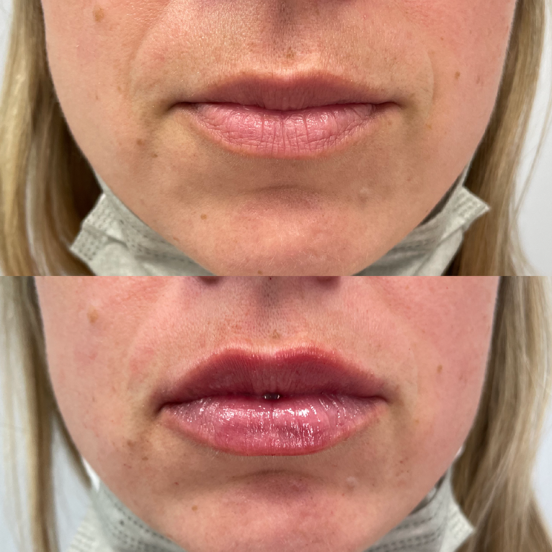 Comparison of woman's lips before and after lip filler treatment; lips are fuller and more defined in the after photo.