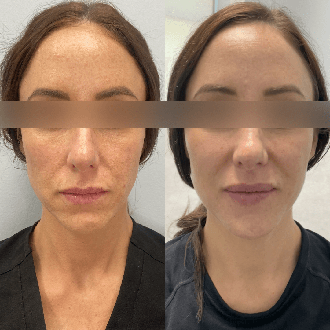 Microneedling in Michigan