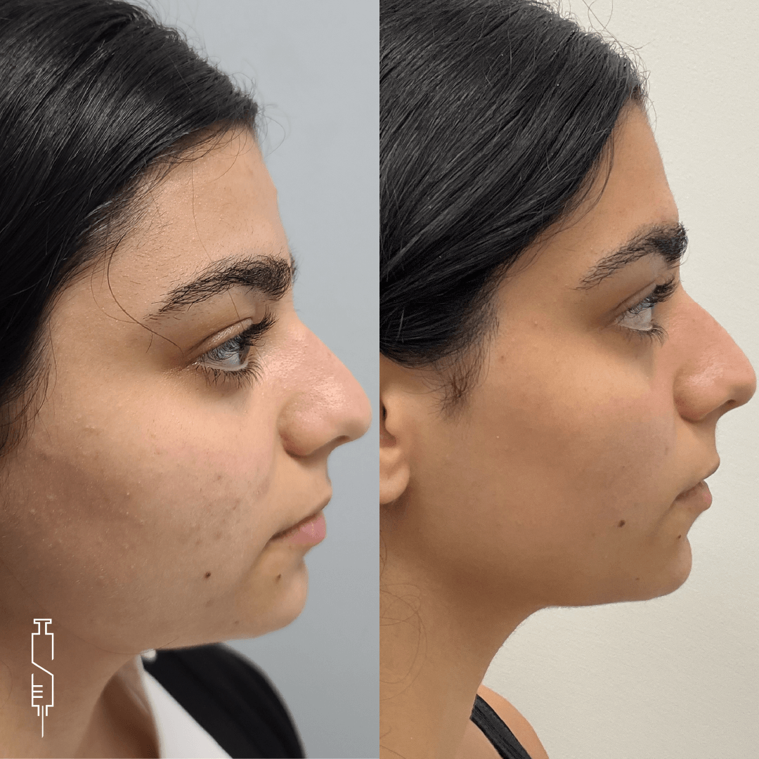 Before and after photos of a nose. Right side shows a thinner and straighter nose.