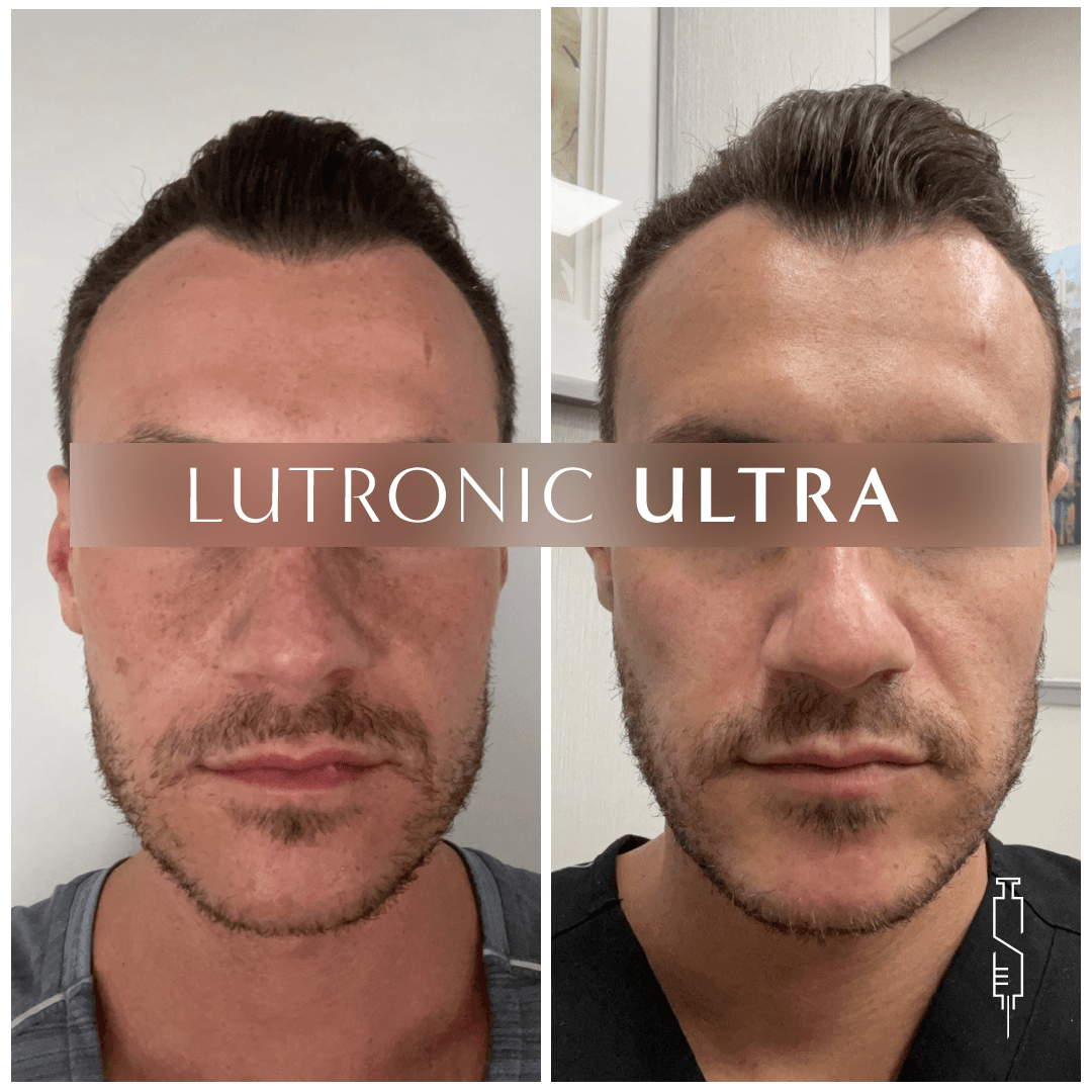 Side-by-side comparison of a man's face before and after a cosmetic treatment, labeled 