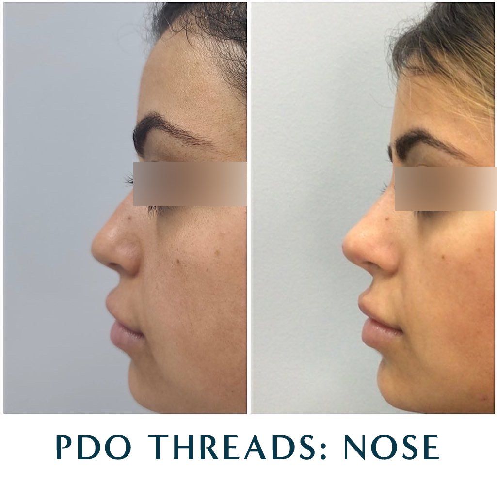 Before-and-after of a person's profile, showing a nose reshaping procedure using PDO threads.
