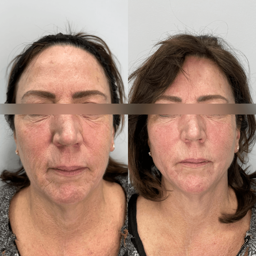 Before and after facial comparison: Wrinkles reduced, skin smoother.