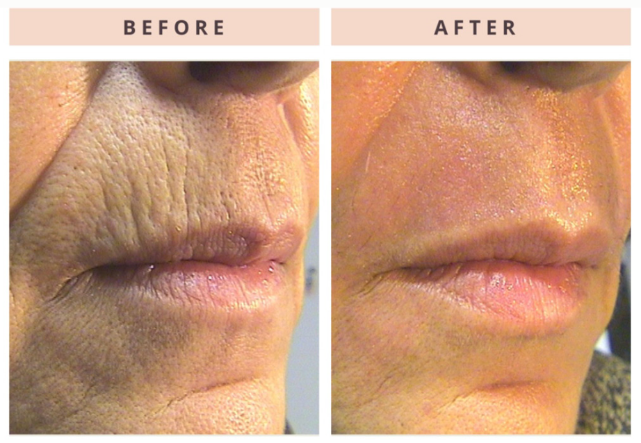 Comparison: Before and after view of a person's mouth, showing reduced wrinkles after a treatment.