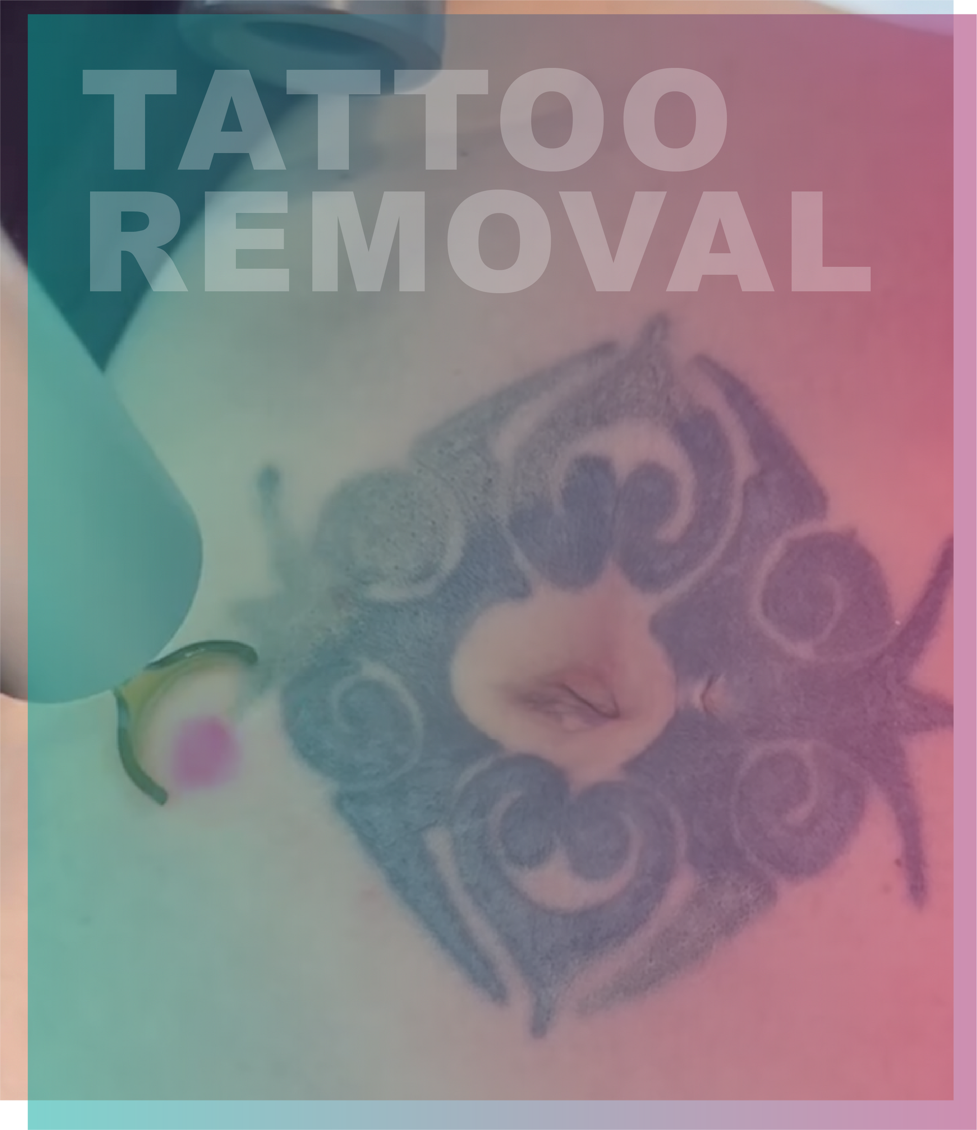 Lutronic laser facial