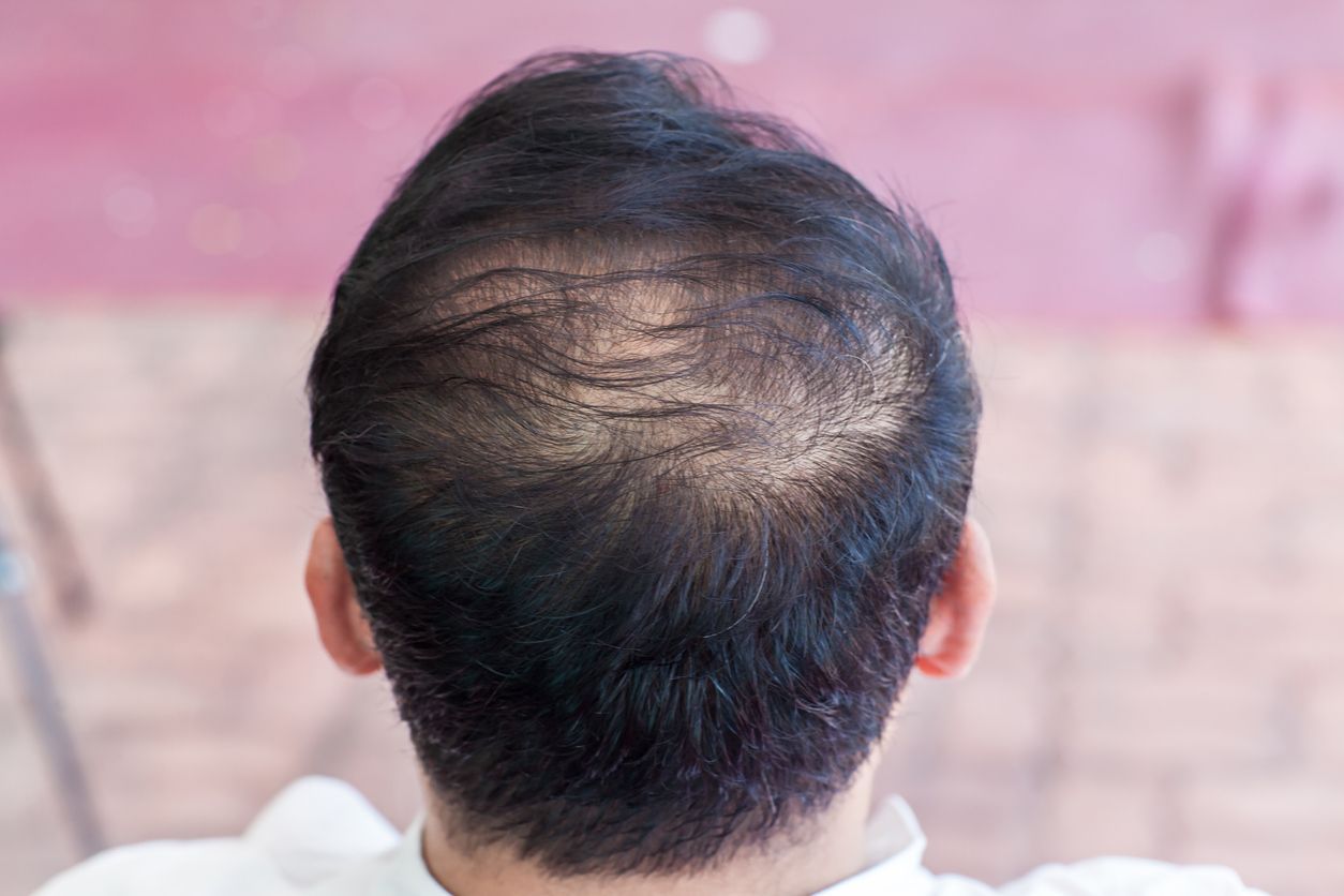 Man's head, viewed from the back, showing thinning dark hair and balding at the crown.