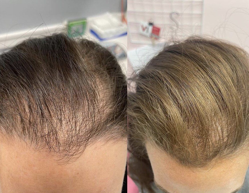 Before and after photos showing hair growth at the hairline. Dark brown hair on the left, light brown on the right.