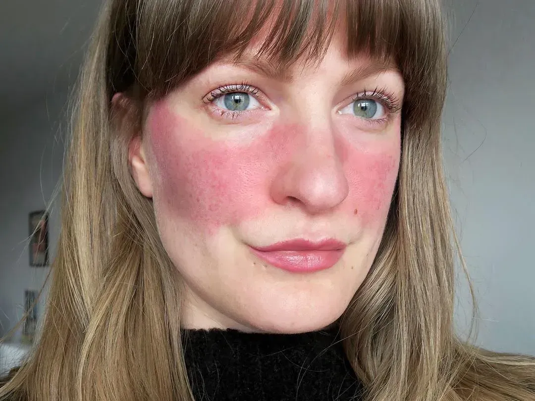 Woman with sunburn on cheeks and nose.