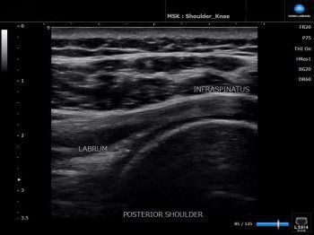 Ultrasound Using SONIMAGE HS1