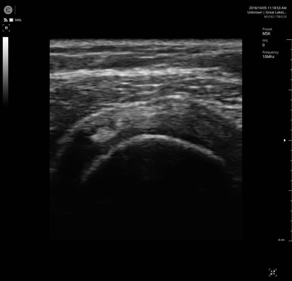 Chest X-Ray Result