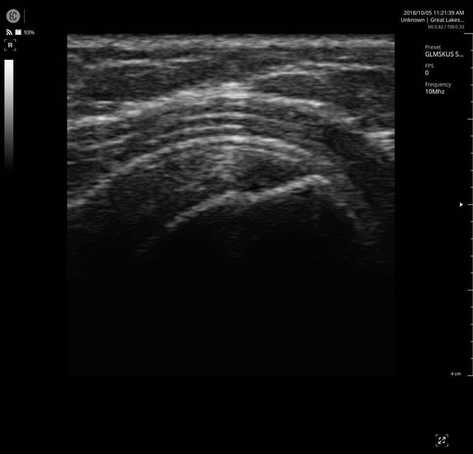 X-Ray Result