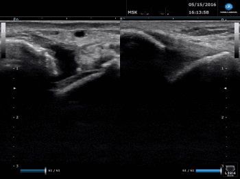 Ultrasound