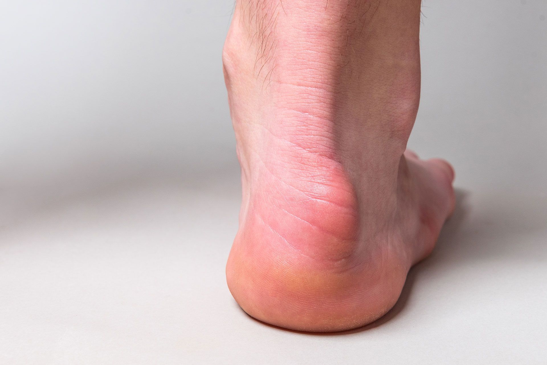 Warts