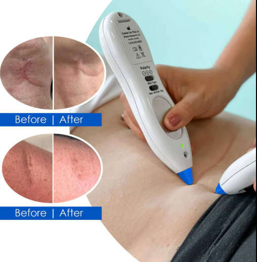 Before-and-after skin treatment on abdomen with handheld device and close-up comparison circles.