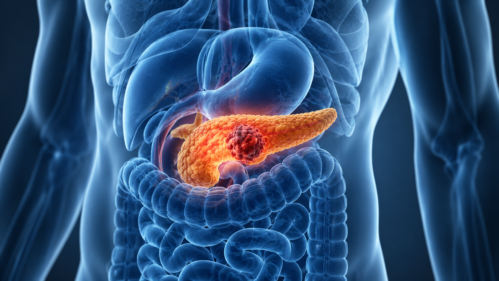 carcinoma pancreático