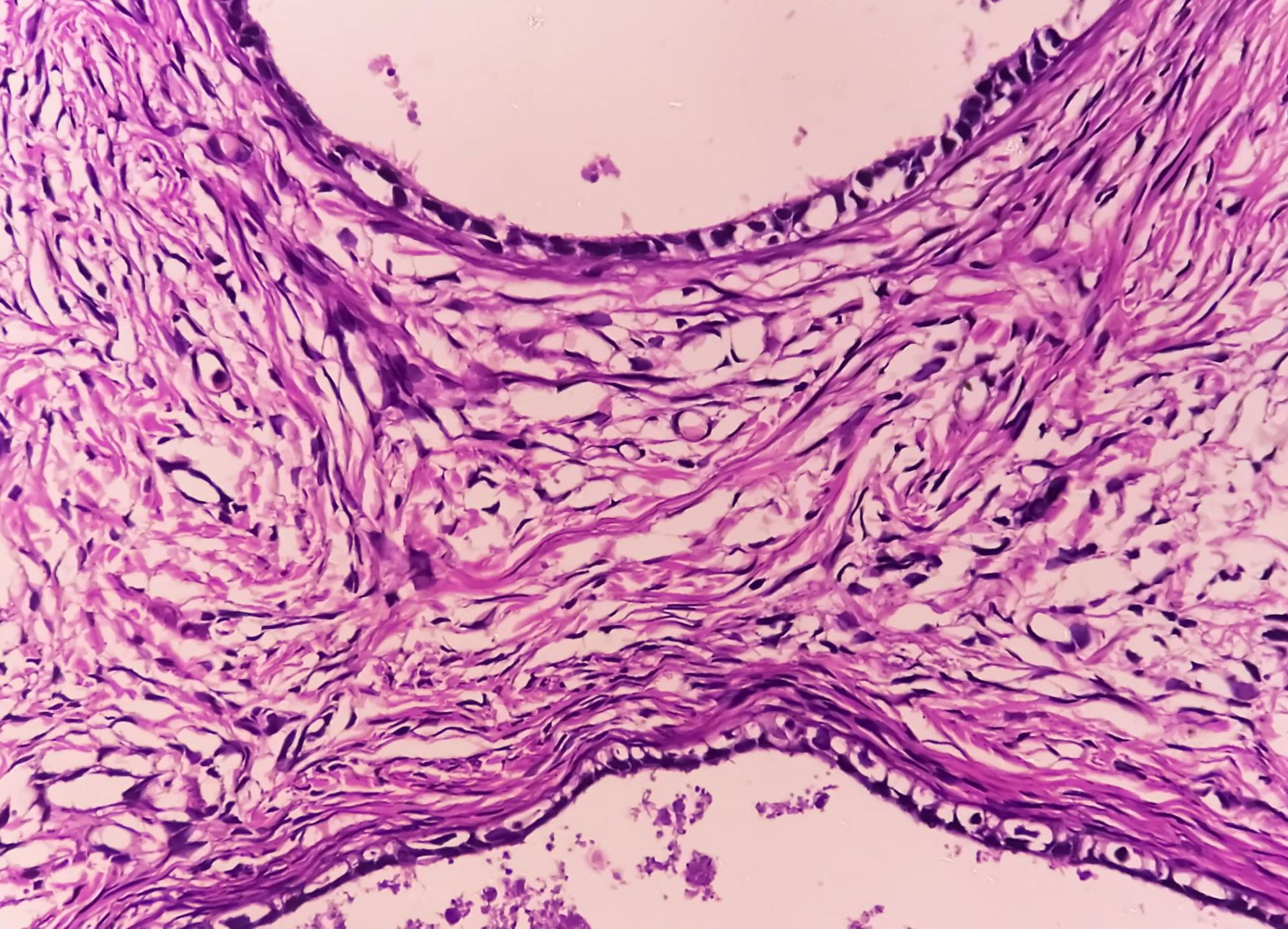 mesotelioma peritoneal