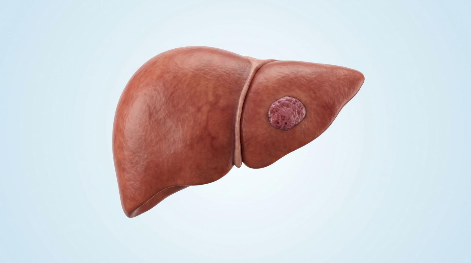 o que é hemangioma