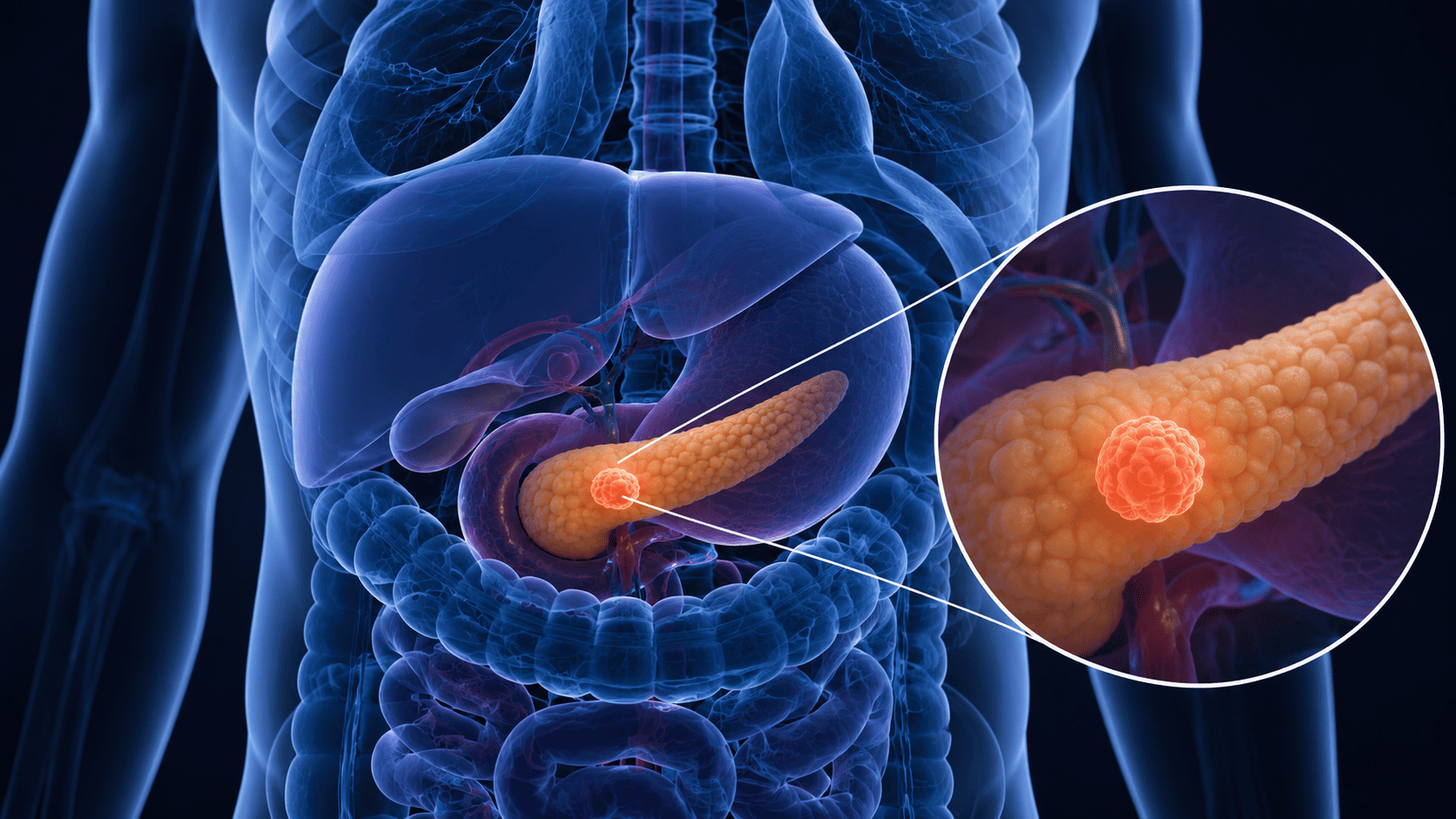 tumor neuroendócrino