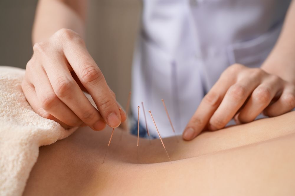 Acupuncturist placing thin needles in a patient’s back during treatment