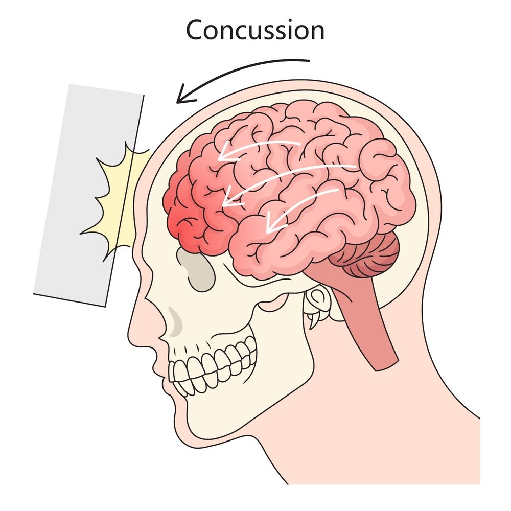 Diagram showing what happens to the brain during a concussion.
