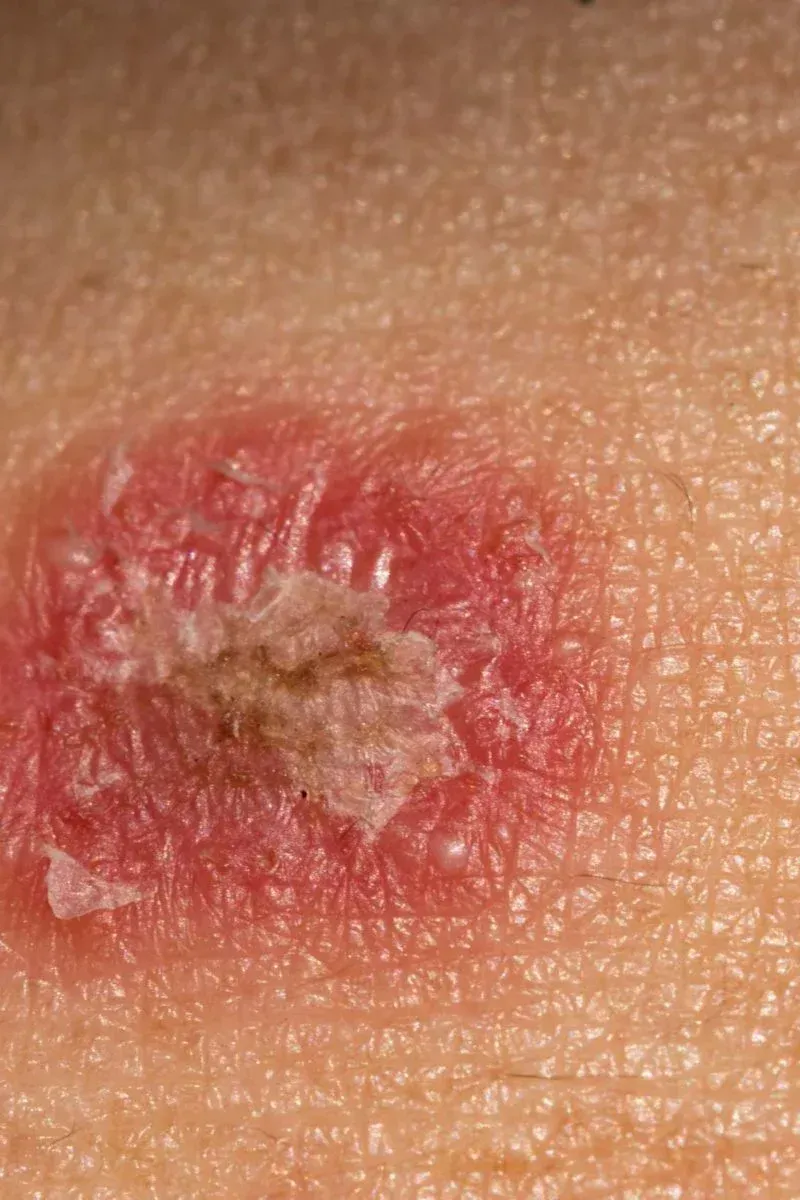 Skin Cancer melanoma process in later stage