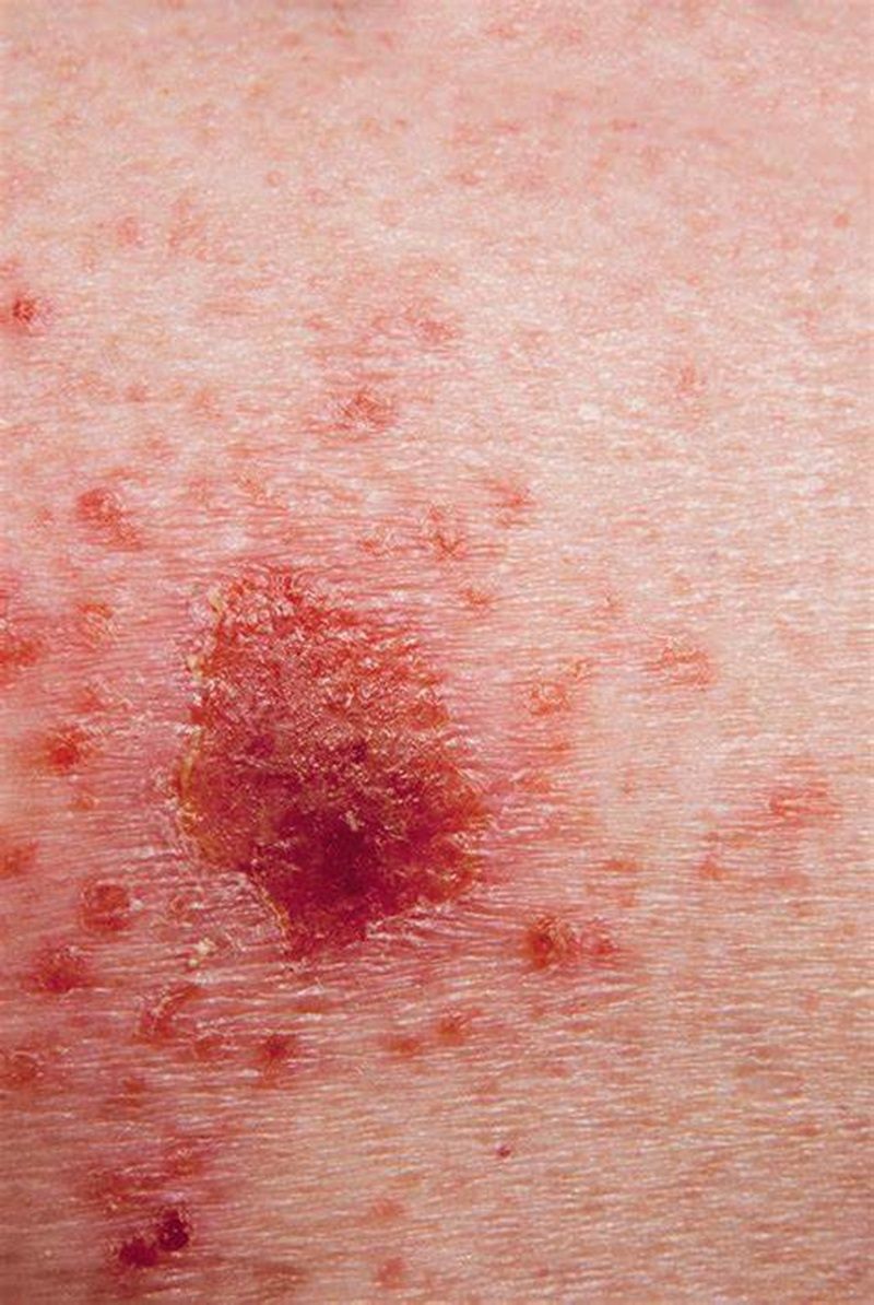 Skin Cancer melanoma starting process