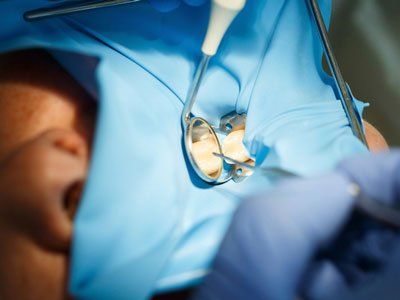3 Things That Could Shorten the Lifespan of Your Dental Filling