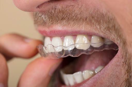How a Night Mouth Guard Could Solve Your Sleep Problems