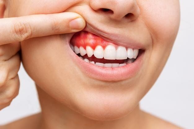 Signs of Periodontal Disease & How to Prevent It