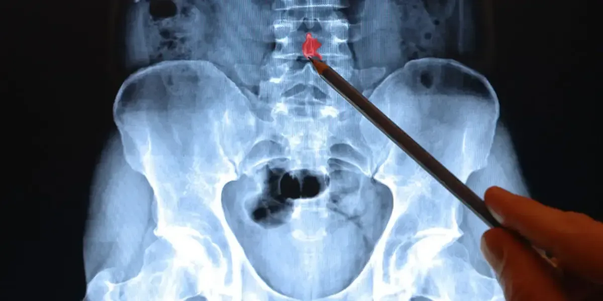 How Do MRI Scans Assist in Diagnosing Spinal Issues?