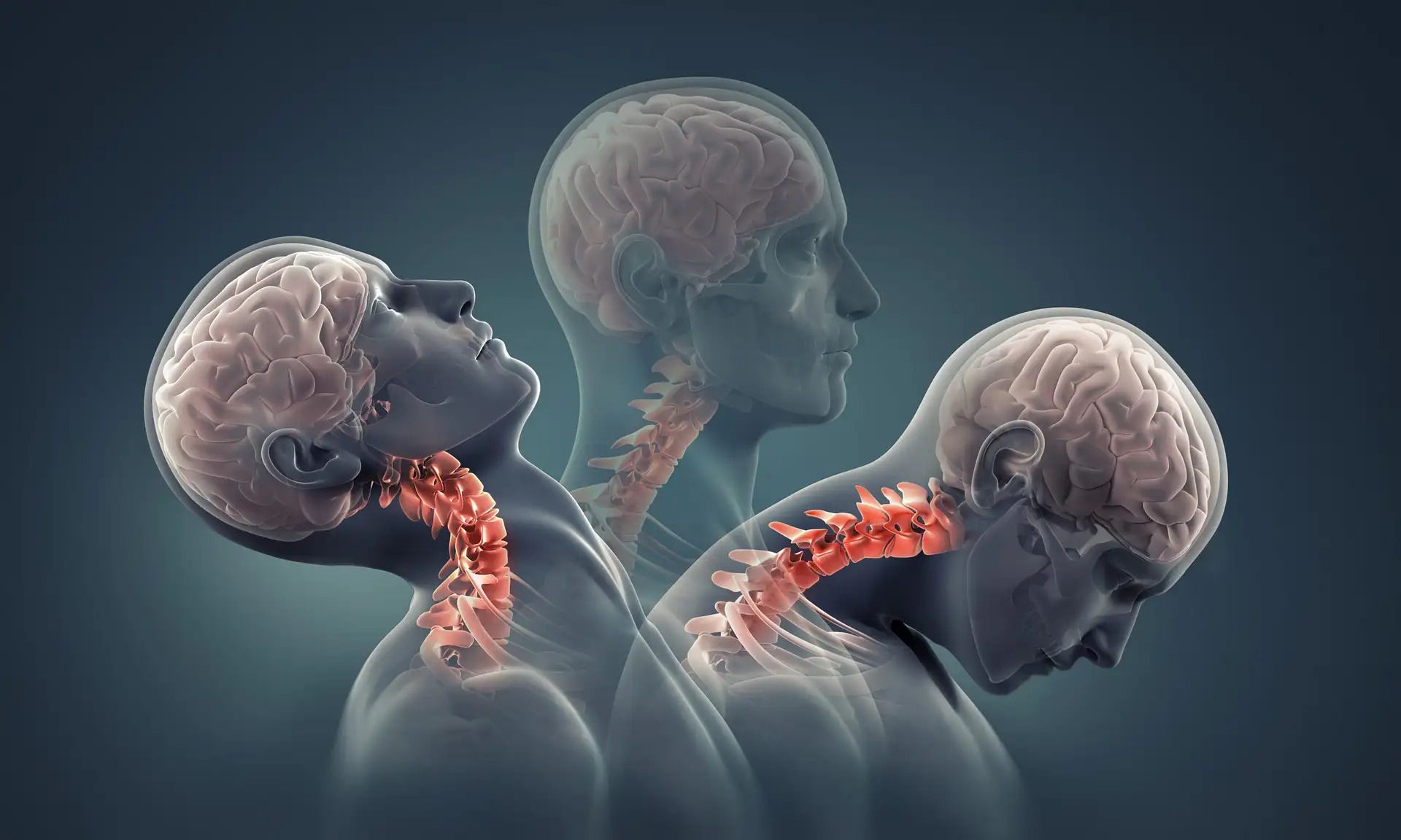 What Is Cranio-Cervical Instability