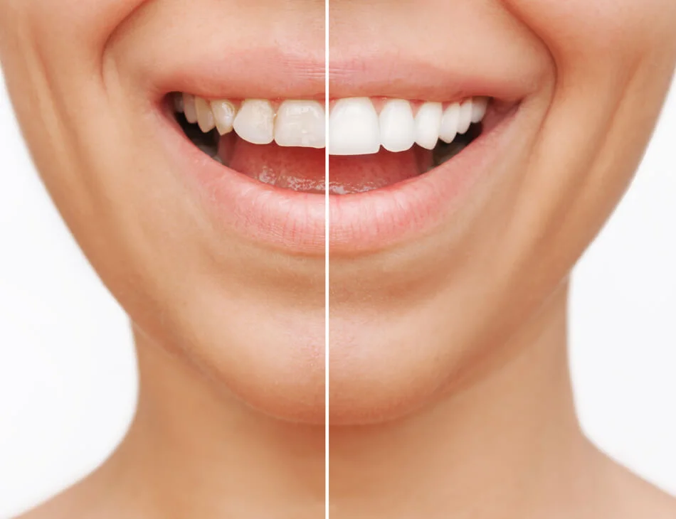 Close-up of a smiling mouth showing teeth, split vertically to compare before and after whitening.