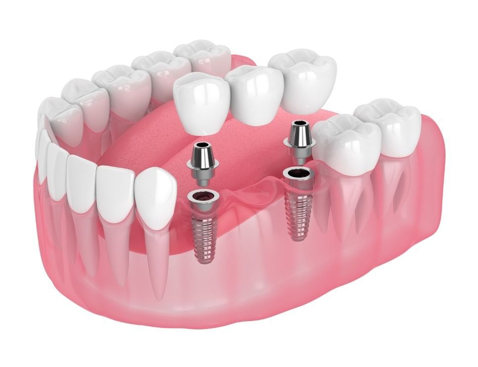 Dental implant model with pink gums, white teeth, and two visible screw implants