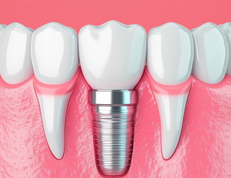 Dental implant in pink gums between white teeth, illustrating tooth replacement.