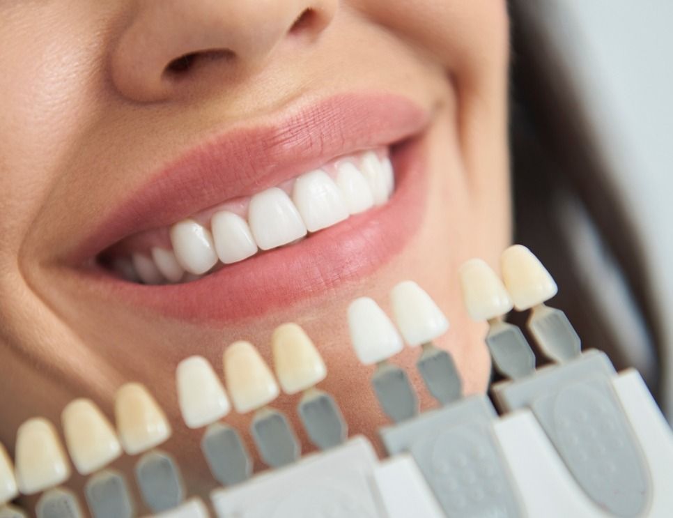 Close-up of a smiling mouth with white teeth beside a shade guide for dental matching