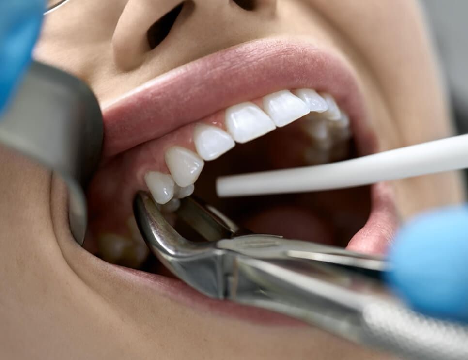 Dental tools cleaning a patient's teeth in a close-up dentist exam