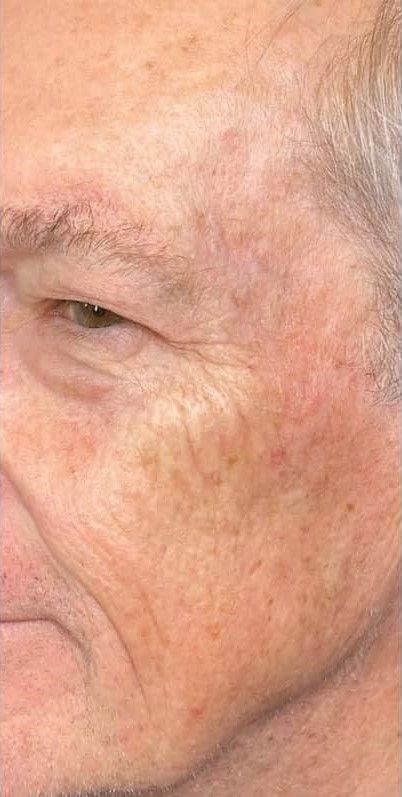 Procell Microchanneling anti-aging treatment before and after comparison.
