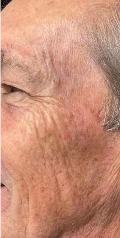 Procell Microchanneling anti-aging treatment before and after comparison.
