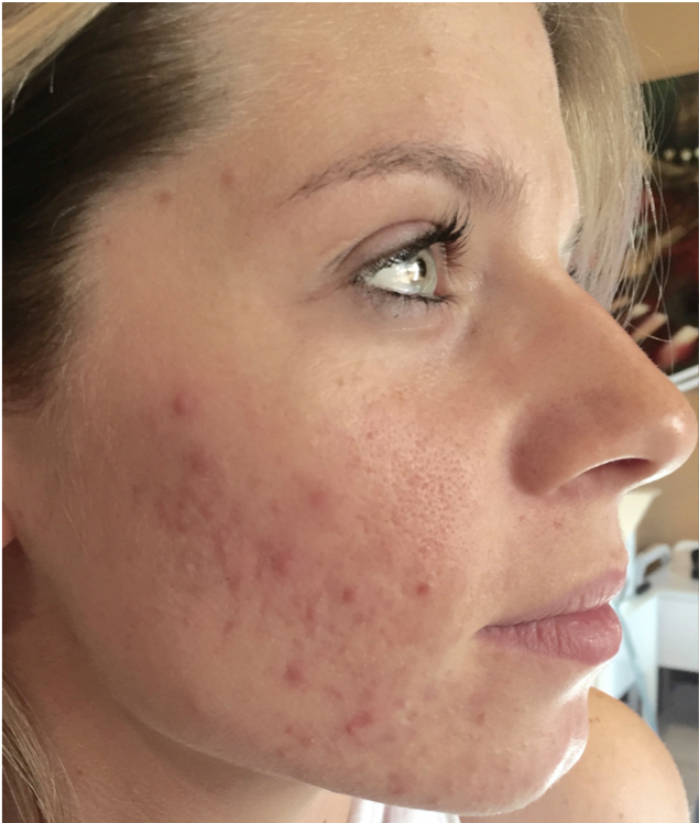 Close-up of a patient receiving a Procell Microchanneling treatment at Devine Medspa.
