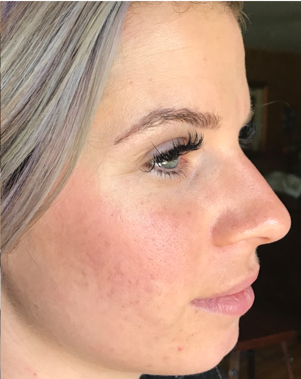 Close-up of a patient receiving a Procell Microchanneling treatment at Devine Medspa.
