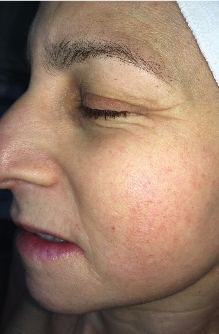 Rosacea treatment before and after images showcasing Procell Microchanneling results.
