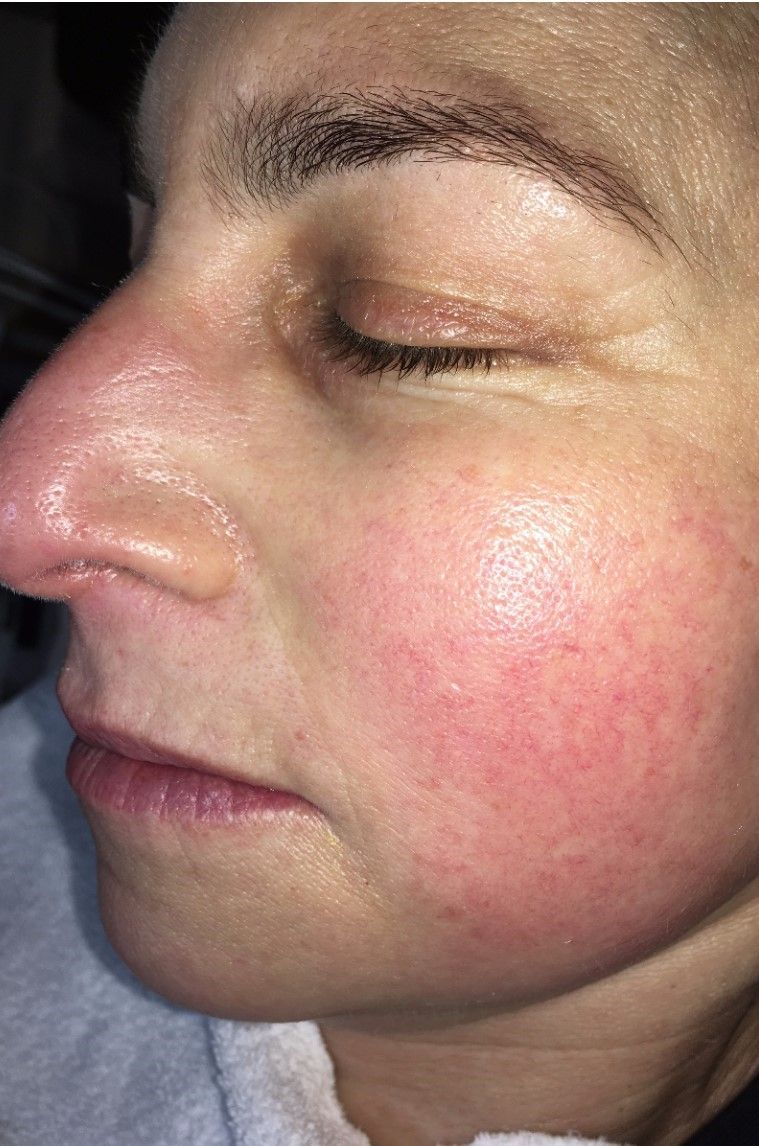 Rosacea treatment before and after images showcasing Procell Microchanneling results.
