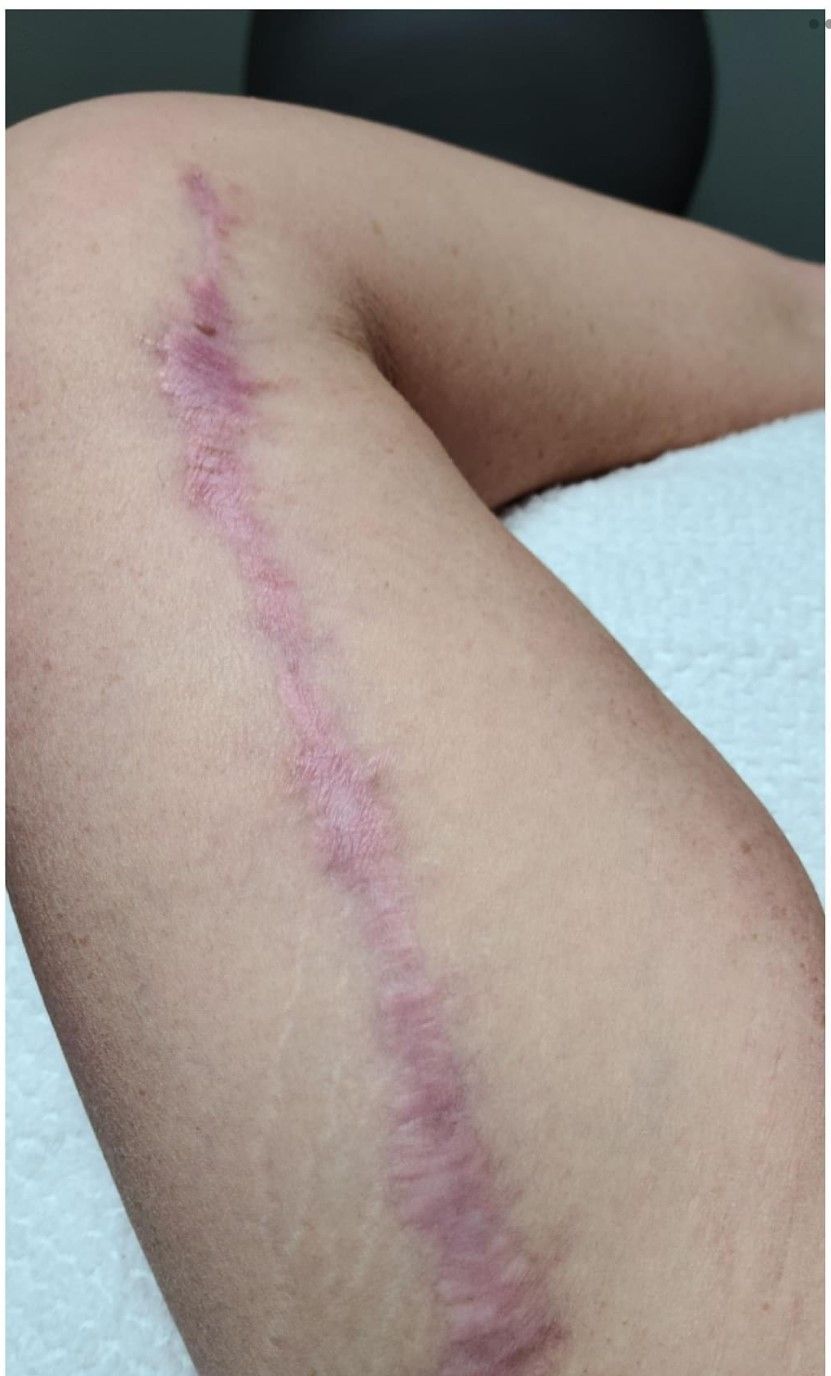 Before and after images of Procell Microchanneling for reducing scars.
