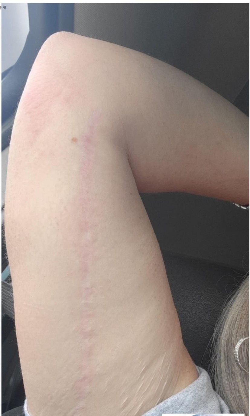 Before and after images of Procell Microchanneling for reducing scars.

