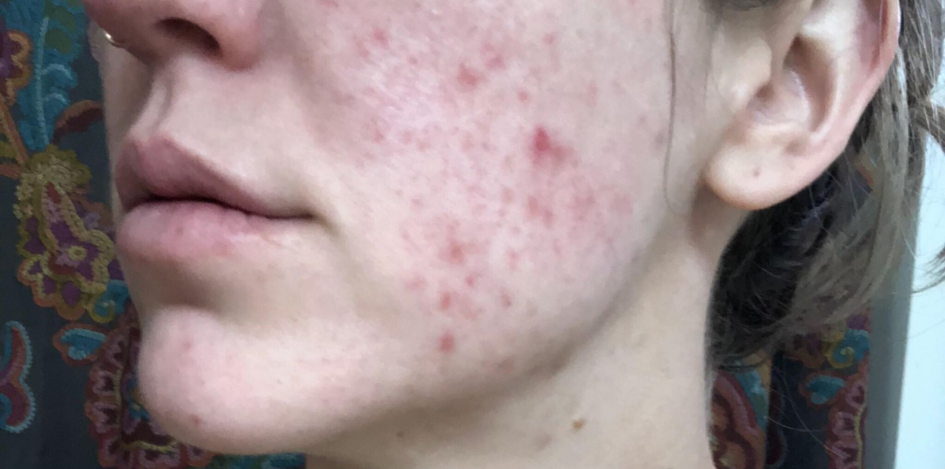 Before and after comparison of acne scarring treatment with Procell Microchanneling.
