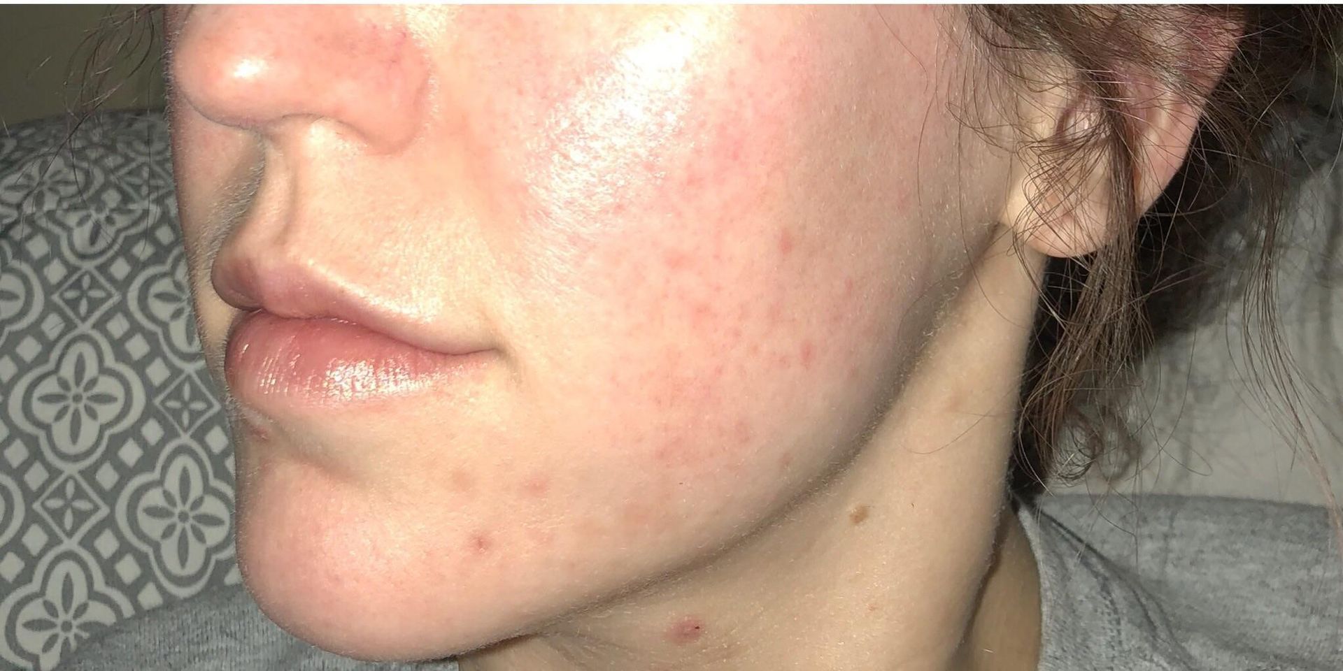 Before and after comparison of acne scarring treatment with Procell Microchanneling.
