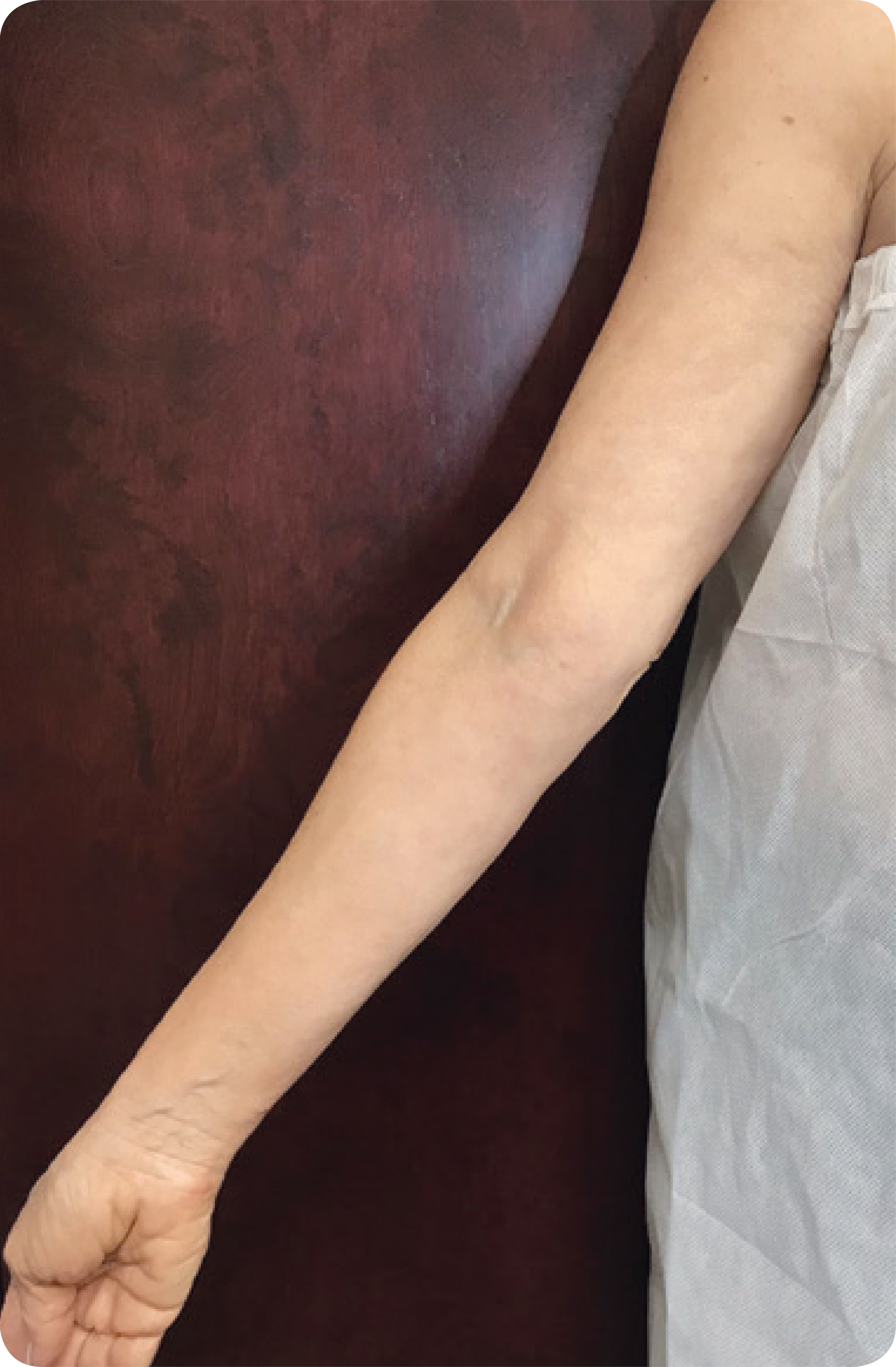 Before and after comparison of skin tightening effects using Procell Microchanneling.
