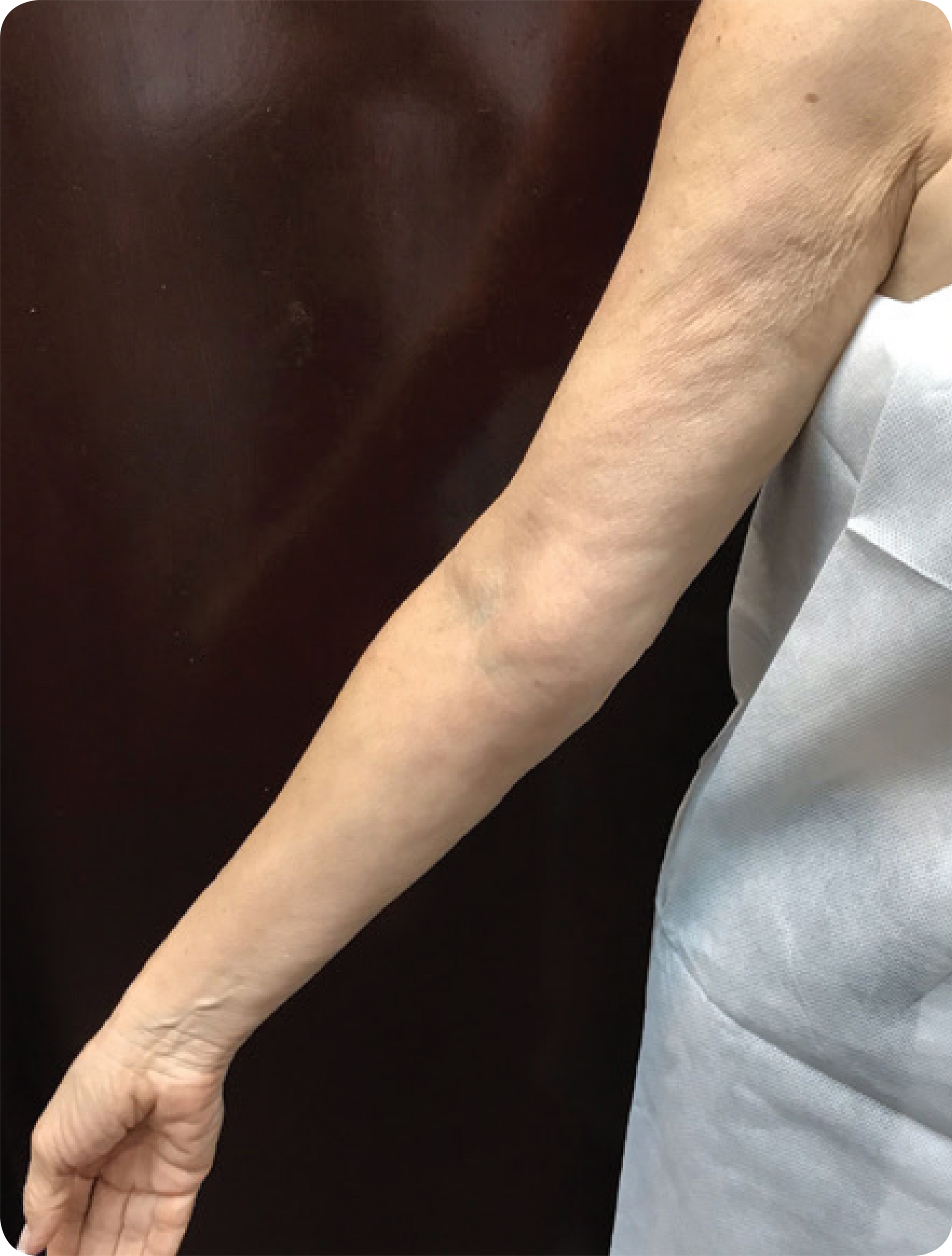 Before and after comparison of skin tightening effects using Procell Microchanneling.
