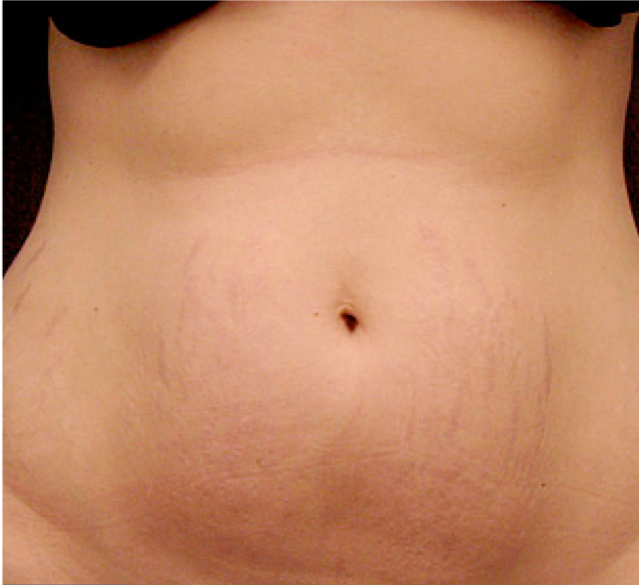 Before and after photos of Procell Microchanneling treatment for stretch marks.
