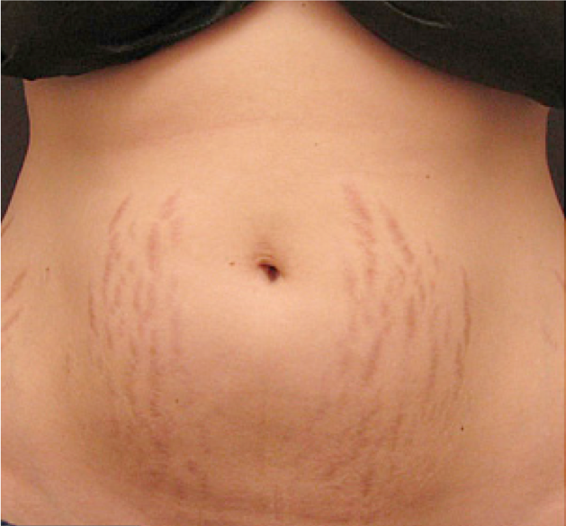 Before and after photos of Procell Microchanneling treatment for stretch marks.
